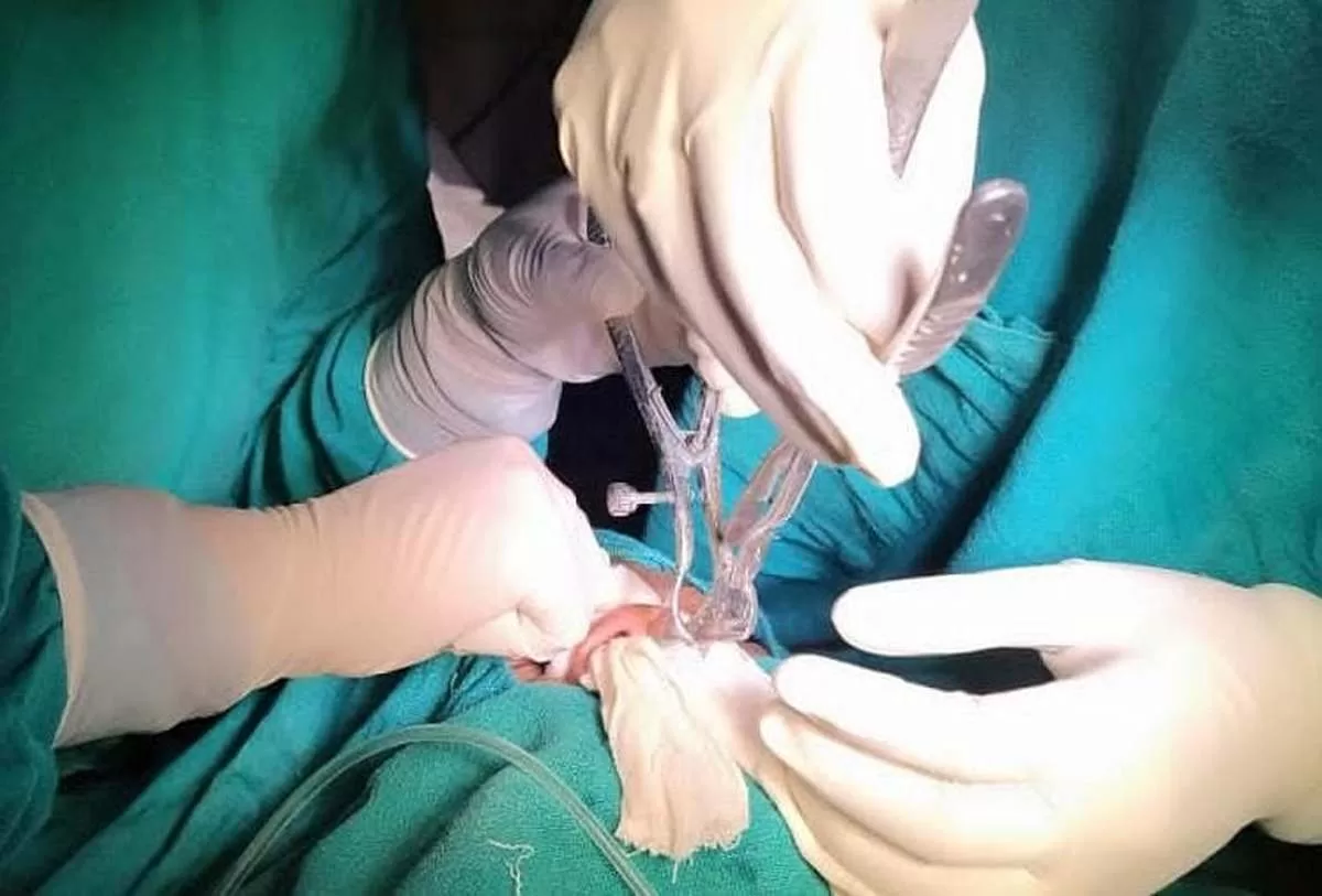 जिला अस्पताल में पहली बार नाक की हड्डी का सफल ऑपरेशन 