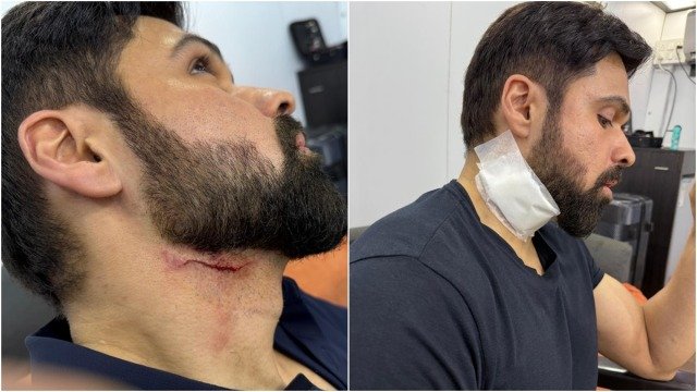 Emraan Hashmi injured during shooting, photo goes viral