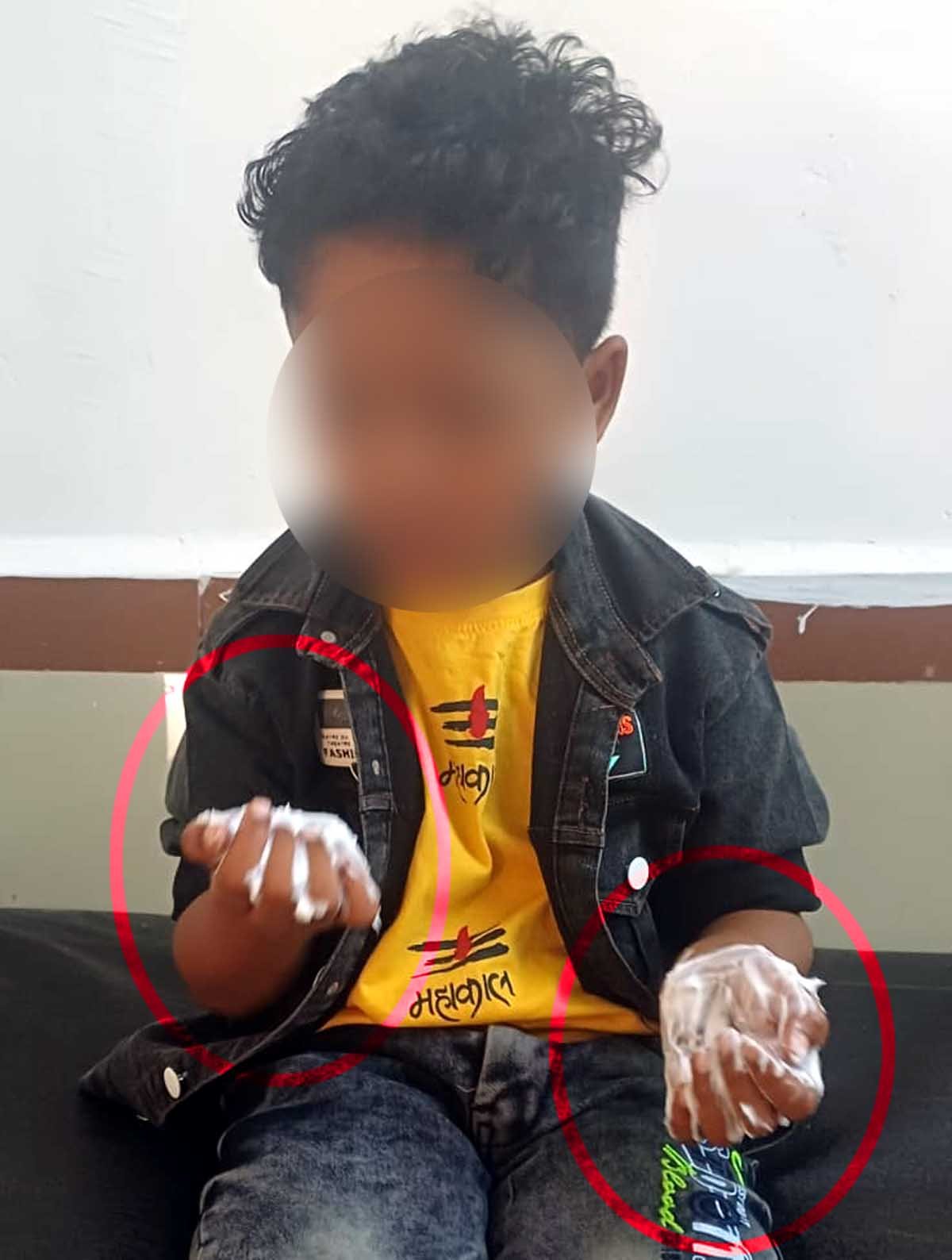 CPE public school student's hand burnt after holding a glass of hot water